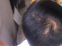 男人梦见头发掉了一撮是什么意思