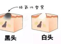 什么是闭口粉刺