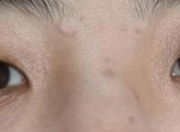 下眼睑干纹细纹怎么消除