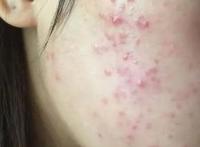 青春期脸上的痘痘怎样才能消除