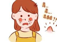 青春期脸上的痘痘怎样才能消除