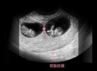 怀孕双胞胎早期有什么特征