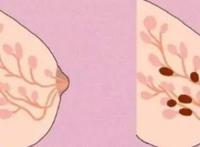 乳腺增生和乳腺结节有什么区别