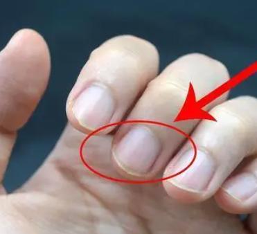 手指甲出现竖纹是肝不好吗