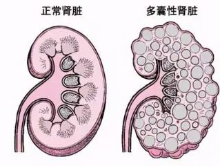 遗传多囊肾一般能活到多少岁