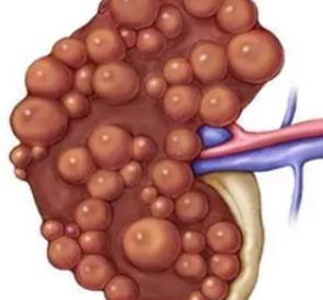 遗传多囊肾一般能活到多少岁