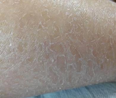 腿上皮肤干燥起皮怎么办