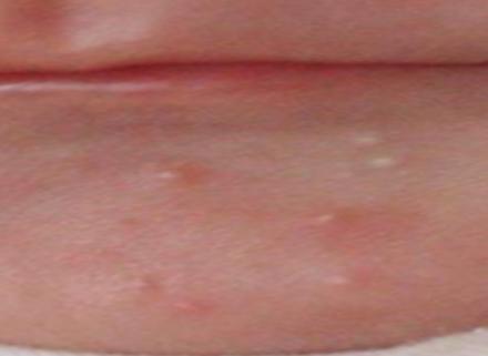 脸上有螨虫的症状图片