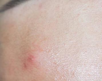 脸上有螨虫的症状图片