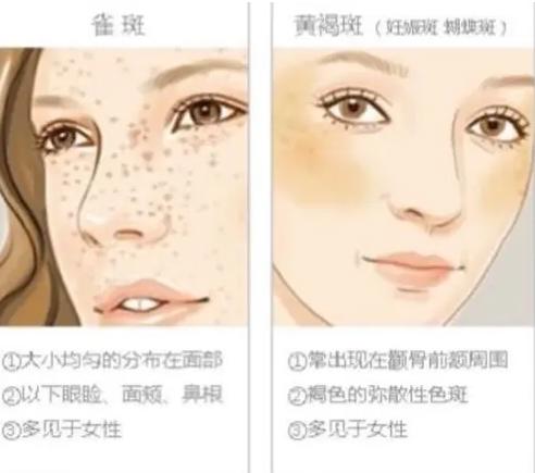 雀斑和黄褐斑区别图