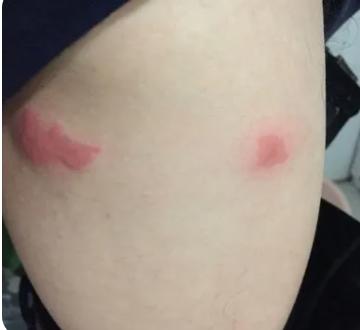 身体痒越抓越痒怎么治还起红疙瘩