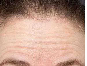 额头细纹多是什么征兆