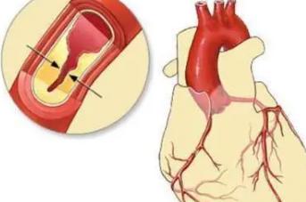 心肌缺血6个征兆