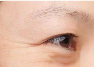 皱纹和笑纹的区别