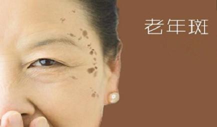 老年斑出现的部位及防治方法