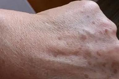 老年斑出现的部位及防治方法