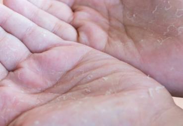 手上粗糙的老皮怎么处理掉