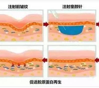 活细胞去皱和打除皱针哪个好