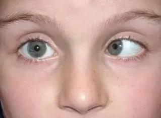 婴儿几个月眼睛不对眼