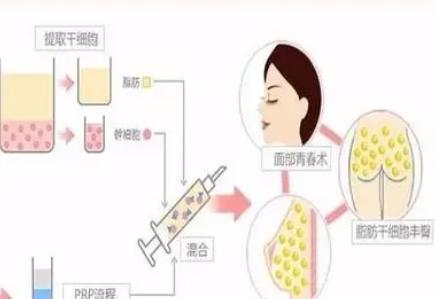 干细胞除皱和肉毒除皱哪个效果好