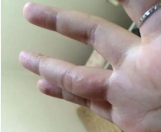 手指有水泡还痒怎么回事