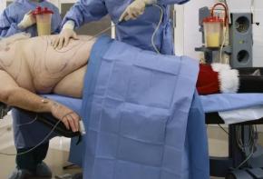 抽脂可不可以减肥