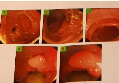 6种症状需做肠镜检查