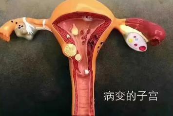 女性下面有炎症的症状