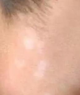 小儿白斑最初期