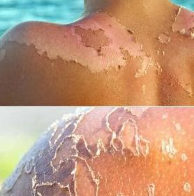 如何快速晒后美白的方法