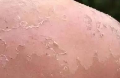 脸部晒伤了怎么快速修复