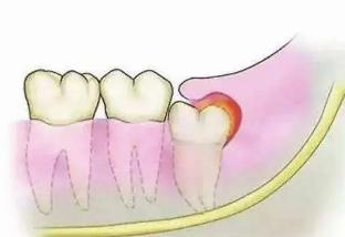 为什么牙医建议尽量不拔智齿