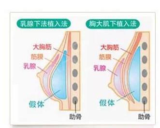 丰胸针注射教程