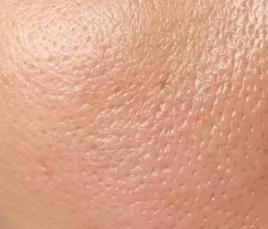 毛孔粗大怎么办4个妙招收缩毛孔