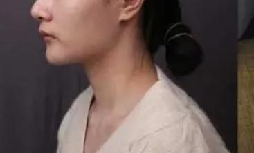 面部磨骨手术的操作流程