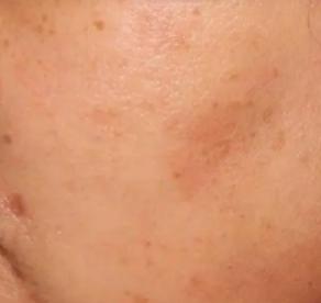 最有效的去除雀斑的方法是什么