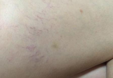 腿上有红血丝是什么原因