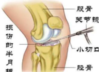 膝关节半月板损伤的最佳治疗方法