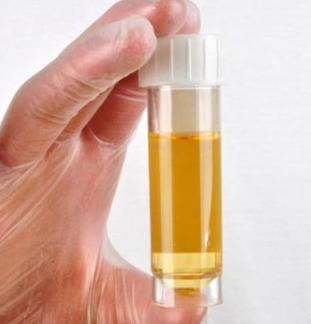 糖尿病早期10个征兆