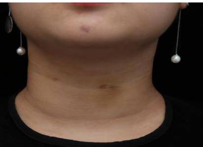 颈纹特别深怎么去除