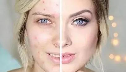 祛痘美白方法是什么