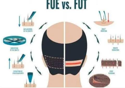 植发技术有哪几种