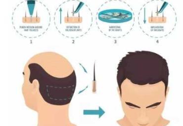 植发技术有哪几种