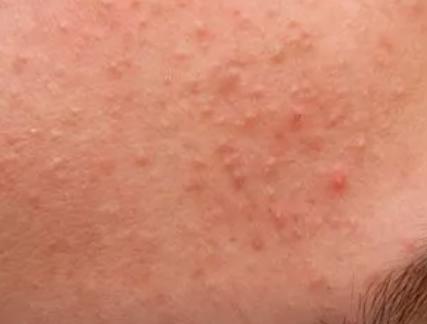 怎样判断脸上有角质图片