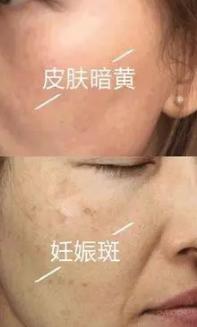 脸部色斑如何快速消除