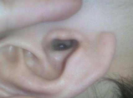 小孩耳朵里面痛是怎么回事