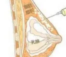 丰胸针多少钱一针及一针管几年