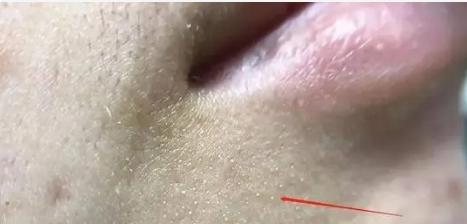 脸上毛孔里全是油脂粒的原因