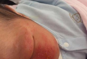 宝宝老是起湿疹怎么办