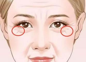 如何去掉鱼尾纹最有效的方法